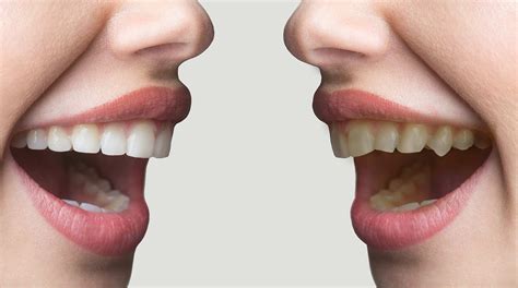 How To Fix Crooked Teeth Dental At Joondalup