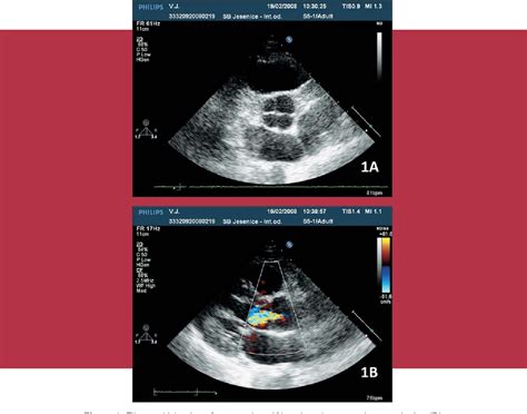 Figure 1 From Assessment Of Quadricuspid Aortic Valve With Real Time Three Dimensional