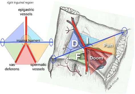 Pdf Systemization Of Laparoscopic Inguinal Hernia Repair Tapp Based