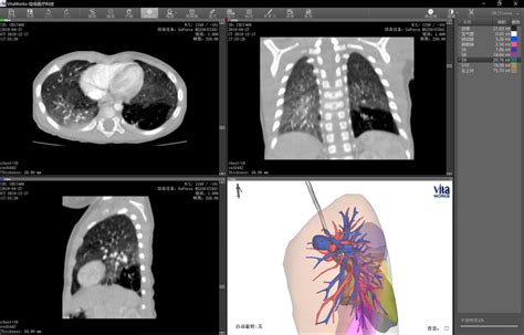 Three Dimensional Computed Tomography Bronchography And Angiography