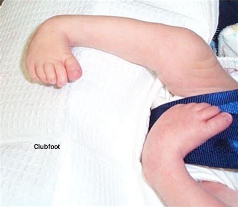 The following are the most common causes of club foot: CTEV (Congenital Talipes Equinovarus) or Clubfoot ...