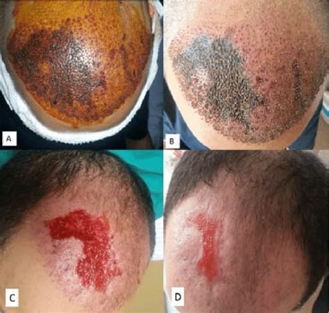 A Appearance Of The Ischemic Findings Of The Scalp 24 Hours After The