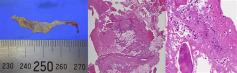 Calcified Amorphous Tumor Presenting With Rapid Growth In The Ascending