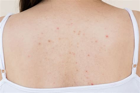 How To Treat Back Acne And Body Acne
