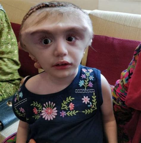 Girl 2 Undergoes Pioneering Surgery In Bid To Shrink Head The Operating Room Global Torg