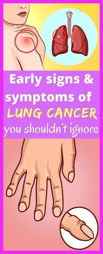 Some Amazing Signs Of Lungs Cancer You Should Aware About This