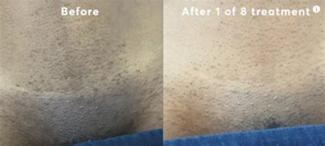 Ingrown Hair Brazilian Laser Hair Removal Before And After Photos