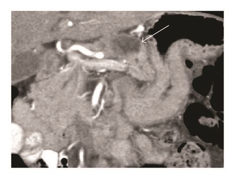 Computed Tomography A A Conglomerate Of Lymph Nodes In The Left