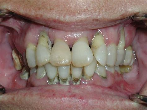 Bad Periodontal Disease Dr Caputo Palm Harbor Dentist