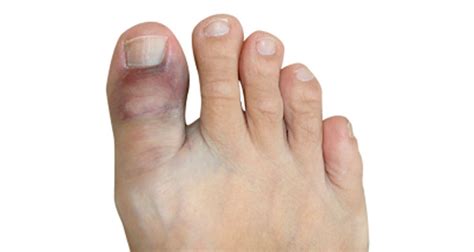 Broken Toe Symptoms Causes Treatment And Rehabilitation