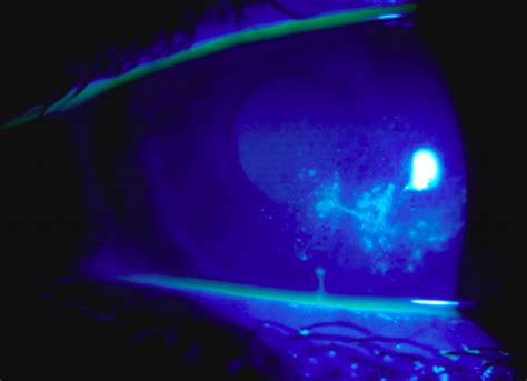 Corneal Abrasion With Stromal Stain Ophthalmology Advisor