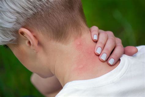 Fly Bites 6 Types Symptoms And Treatment