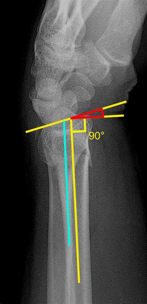 Distal Radius Fracture X Ray Wikidoc