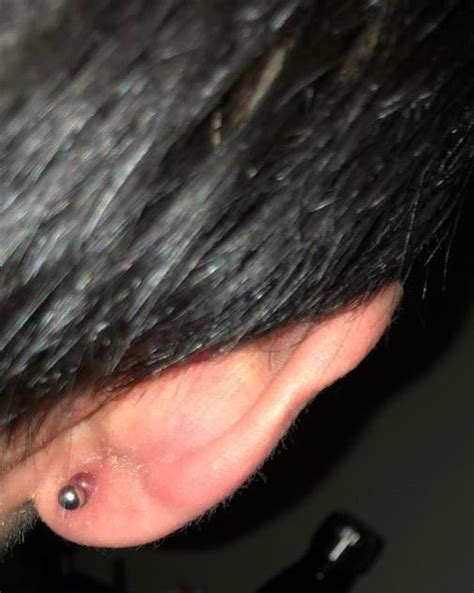 What Is This Huge Boil Looking Thing Thats Behind My Ear Piercing