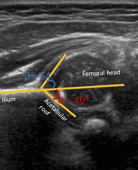 Developmental Dysplasia Of The Hip Pediatrics American Academy Of