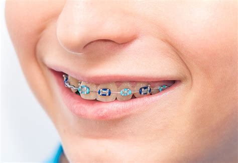 Braces For Childrens Teeth Cost Types And More