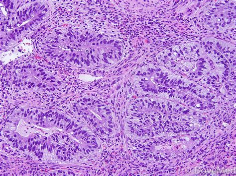 Invasive Adenocarcinoma Of Lung