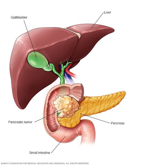 Main causes for pancreatic cancer in dogs the causes for canine pancreatic cancer are not well understood. Pancreatic cancer Disease Reference Guide - Drugs.com