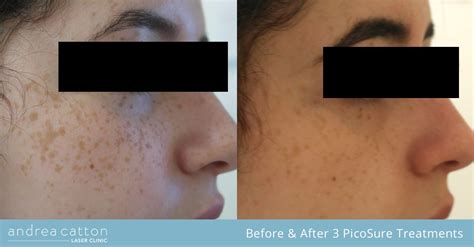 Laser Freckle Removal Uk Picosure Fla And Revlite Andrea Catton Laser Clinic