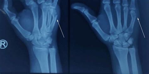 Metacarpal Fracture Hypetiklo