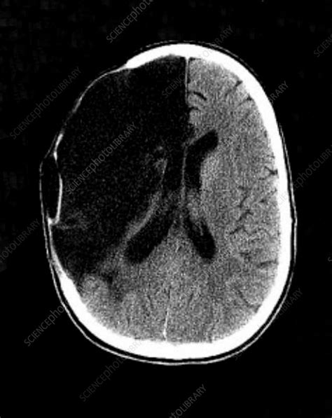 Brain Stroke Ct Scan Stock Image C0272376 Science Photo Library