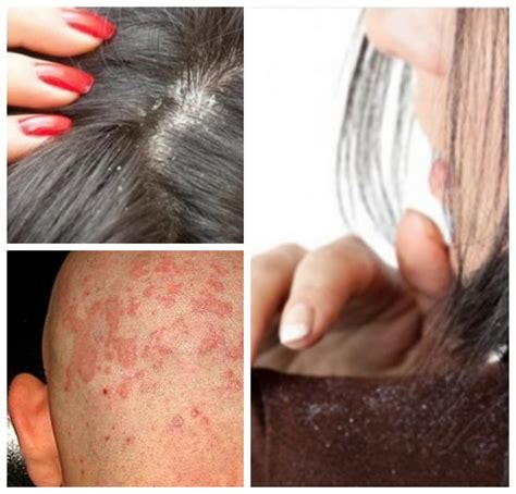 Effectively Managing And Minimising Symptoms Of Scalp Eczema Makeup Files