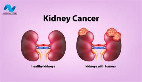 What causes kidney cancer (renal cell cancer)? Kidney Cancer: Symptoms,Causes & Diagnosis Treatment | NU ...