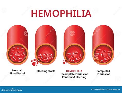 Hemofilia Vaso Sanguíneo Dañado Desorden De La Coagulación De La