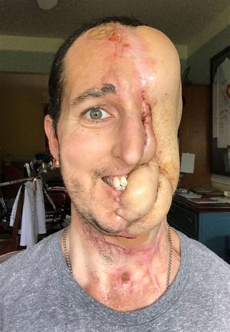 Mucormycosis is any fungal infection caused by fungi in the order mucorales.:328 generally, species in the mucor, rhizopus, absidia, and cunninghamella genera are most often implicated. Man who lost half his face to melon-size cancerous tumour ...