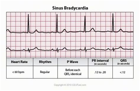 Which Of The Following Statements Regarding Sinus Bradycardia Is Correct