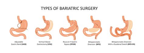 Gastric Sleeve How S It Work Cost Risks Recovery Etc