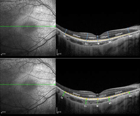 Measurement Map Of The Thicknesses Of The Retina And Choroid The