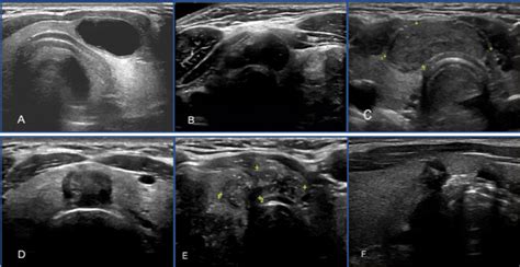 Acr Ti Rads And Ata Ultrasound Classifications Are Helpful For The