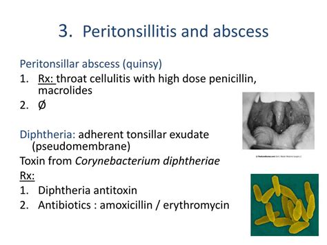 Bartholin Abscess Antibiotic Treatment