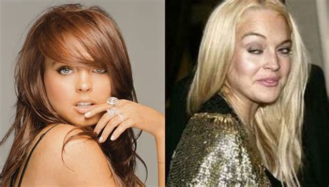 Top 10 Botched Plastic Surgery Fails Plastic Surgery Before And Vrogue