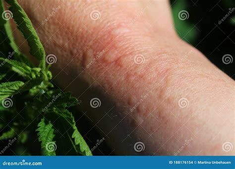 Stinging Nettles And An Arm With Nettle Stings Stock Photo Image Of Herbs Natural