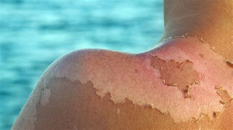 There's no excuse for not practicing sun safety, but for those rare instances when sunburns do happen, now you're armed with expert tools and tips to further prevent. The U.S. Spends Millions on Treating Sunburns, Study Finds ...
