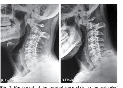 Figure 1 From Old And Neglected Odontoid Fracture With C1 C2