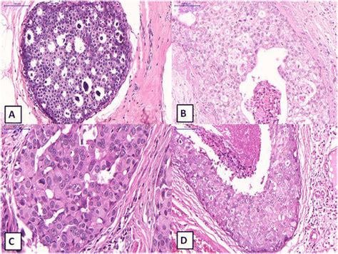 Ductal Carcinoma In Situ Of The Breast Different Nuclear Grades And
