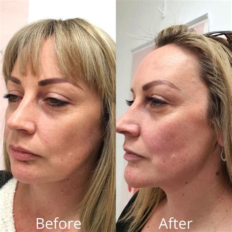 Thread Lift Before And After Clinical Images