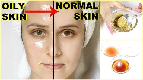 Oily Skin Treatments