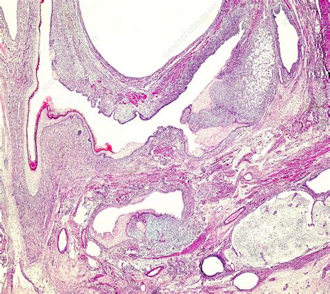 Ovarian Mucinous Cystadenoma Light Micrograph Stock Image C050