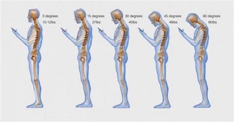 The Number One Way You Are Killing Your Posture Champion Physical