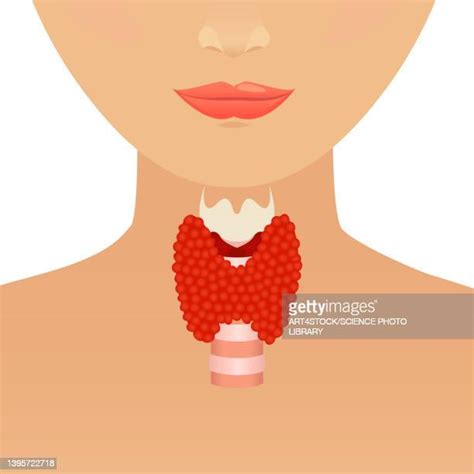 Thyroid Goiter Photos And Premium High Res Pictures Getty Images