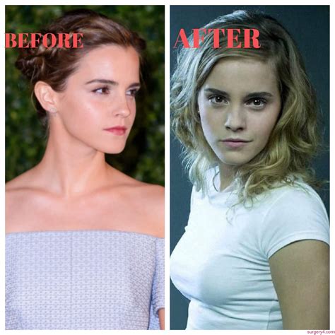 Emma Watson Plastic Surgery Boob Job Photos Before After Surgery