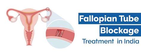 Fallopian Tube Blockage Treatment IVF In India By Top Fertility Doctor