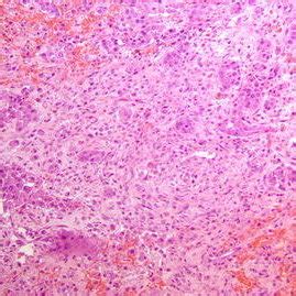 Epithelial mesothelioma cells can develop in the lining of the lungs, abdomen or heart. Cytology of pleural fluid. Clumps of neoplastic cells with ...