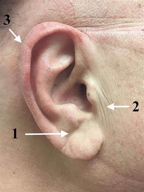 Cureus Unified Anatomical Explanation Of Diagonal Earlobe Creases Preauricular Creases And