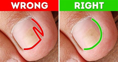 How To Fix An Ingrown Toenail Who Should You See And What Should You