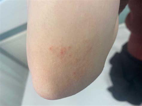 Suprapubic And Elbow Rashes